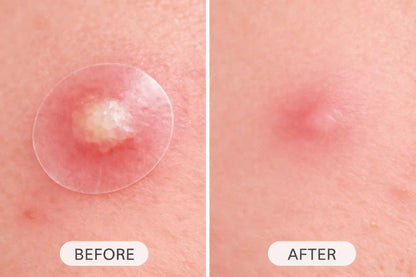 NAQAWATI™ Premium Invisible Acne Patch