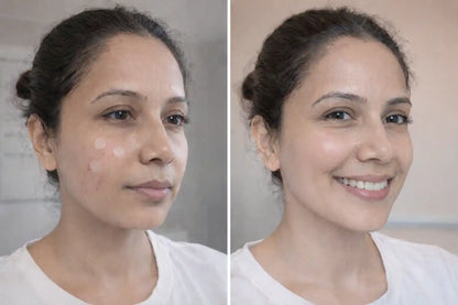 NAQAWATI™ Premium Invisible Acne Patch