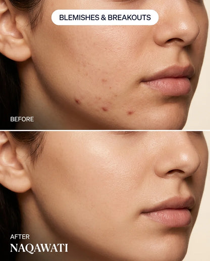 Naqawati™ Hydrocolloid Pimple Patches