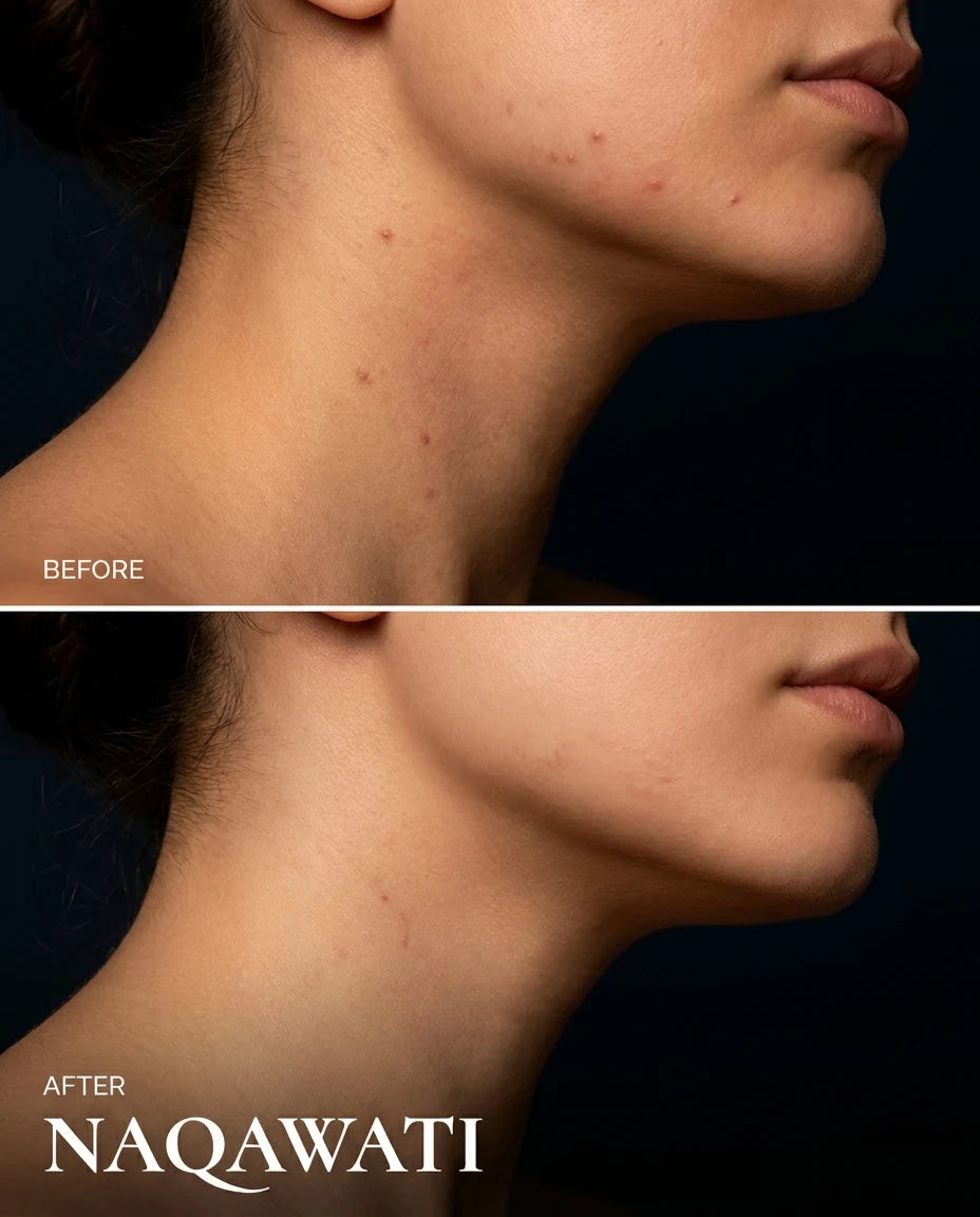 Naqawati™ Hydrocolloid Pimple Patches