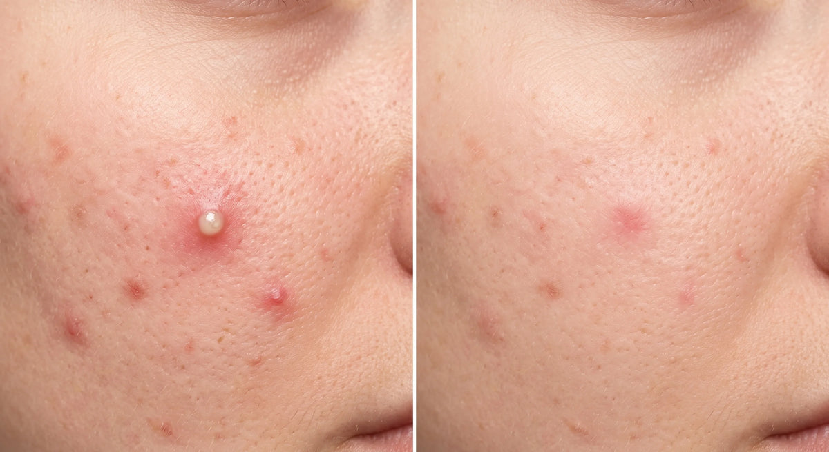 Naqawati™ Hydrocolloid Pimple Patches