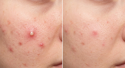 Naqawati™ Hydrocolloid Pimple Patches